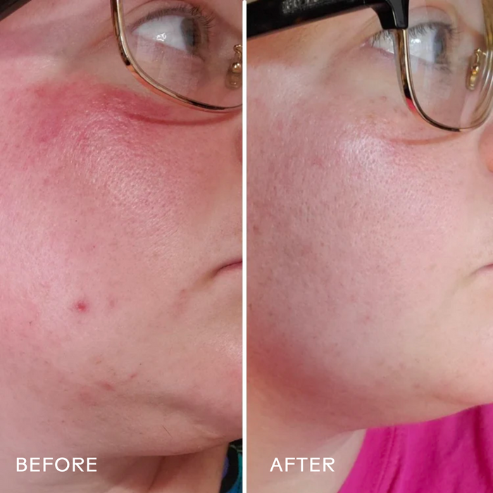 Side-by-side close-ups of a person’s cheek: the Before image shows redness and blemishes, while the After image reveals smoother, clearer skin after using Three Ships Radiance Grape Stem Cell + Squalane Ultra-Hydrating Cream.