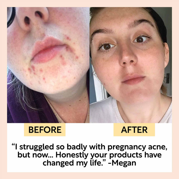 Side-by-side images depict the transformative effects of UpCircles The Discovery Set on a womans face. The Before image shows acne, while the After reveals clearer skin. Caption: “I struggled with pregnancy acne... UpCircle’s products changed my life.”.